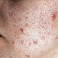 Understanding the Most Common Causes of Acne: What Really Triggers Breakouts?